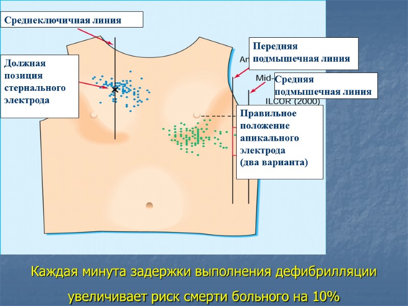 Каждая минута задержки выполнения дефибрилляции увеличивает риск смерти больного на 10%  Среднеключичная линия